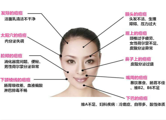 原來這些因素會導(dǎo)致長痘痘！你知道嗎?