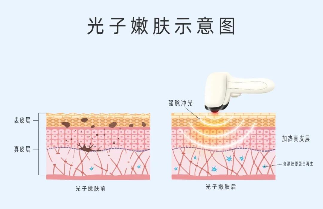 做好術(shù)后修復，拒絕“無效醫(yī)美”